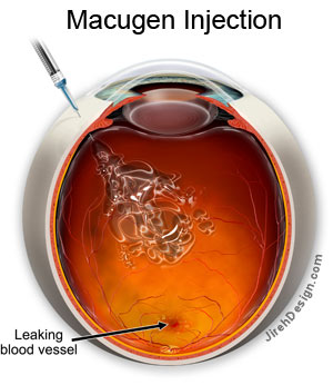 diabetes and the eye